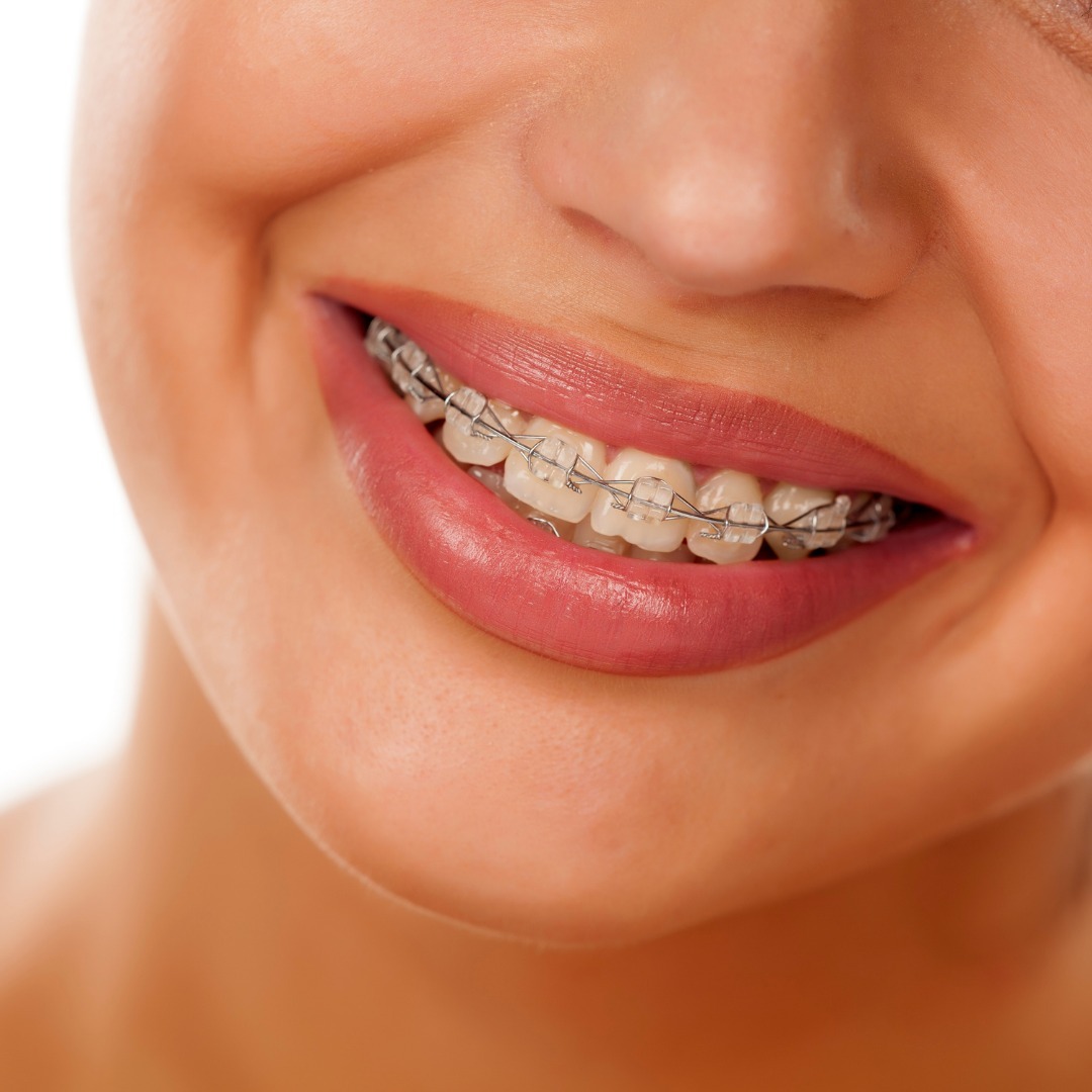 Best affordable Henderson Orthodontists