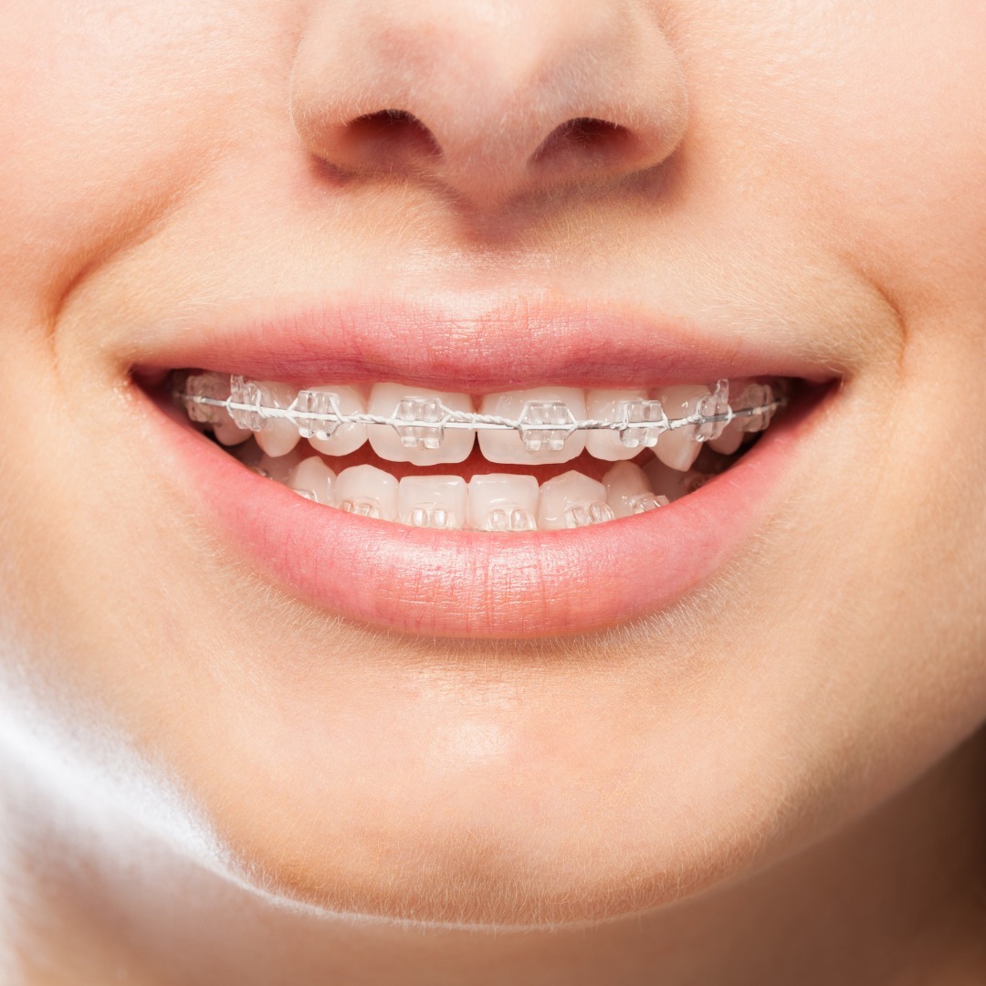 Invisible braces cost in Henderson