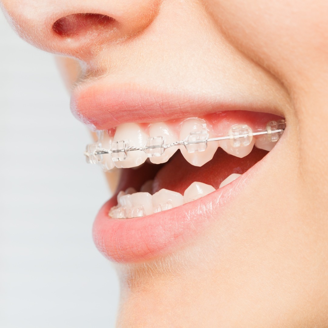 Invisible Braces cost in Henderson NV 