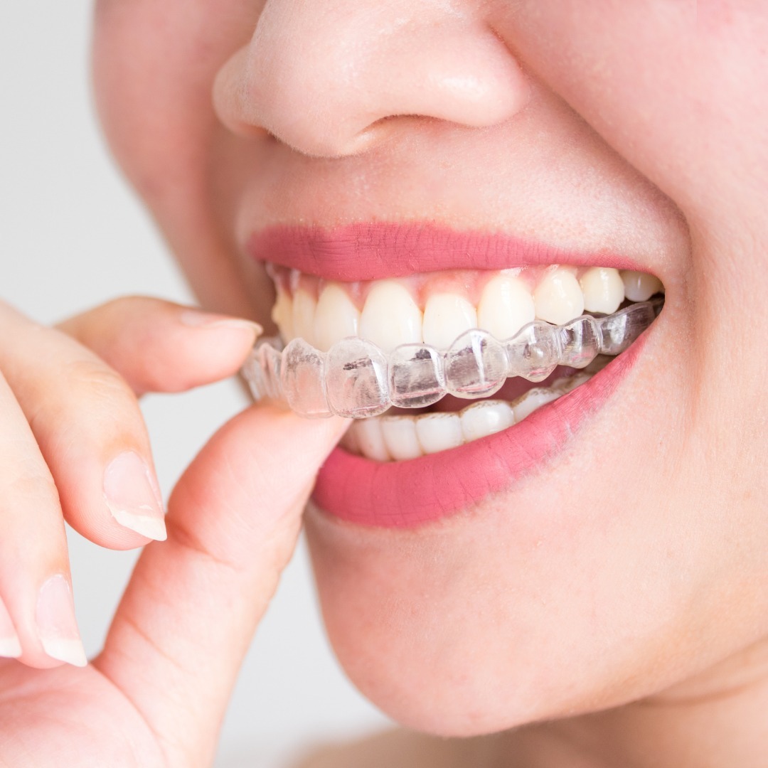 Affordable Invisalign quotes Henderson NV 