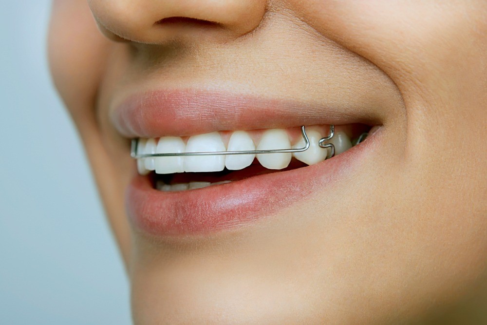 Orthodontic retainers cost in Henderson